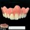 Protesi superiore overdenture su barra.